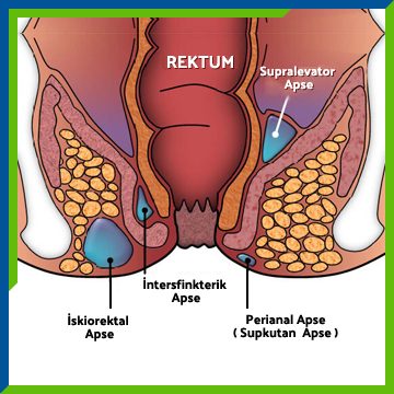 Prokto-AnalApse-TR
